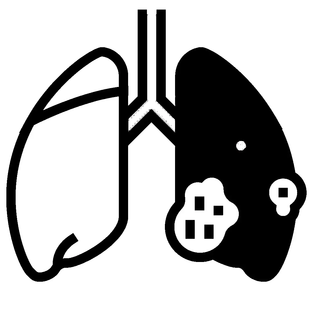 Doenças Pulmonares Intersticiais / Pneumonite